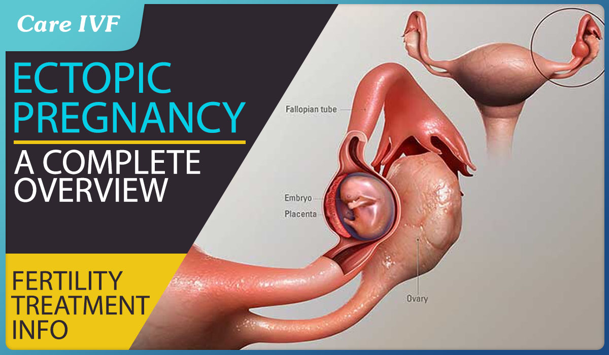 Ectopic Pregnancy Symptoms Risk Factors Causes Treatment Options 